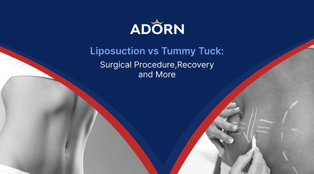 Liposuction Tummy Tuck Ahmedabad India