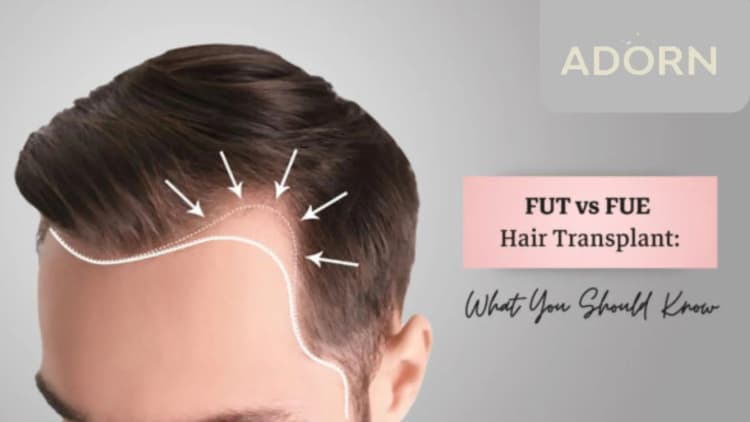 FUE vs. FUT: Which Hair Transplant Method Is Right for You? Fue vs Fut hair transplant
