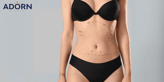 Liposuction in Ahmedabad: Cost, Procedure, & Recovery Liposuction in Ahmedabad Cost, Procedure, & Recovery